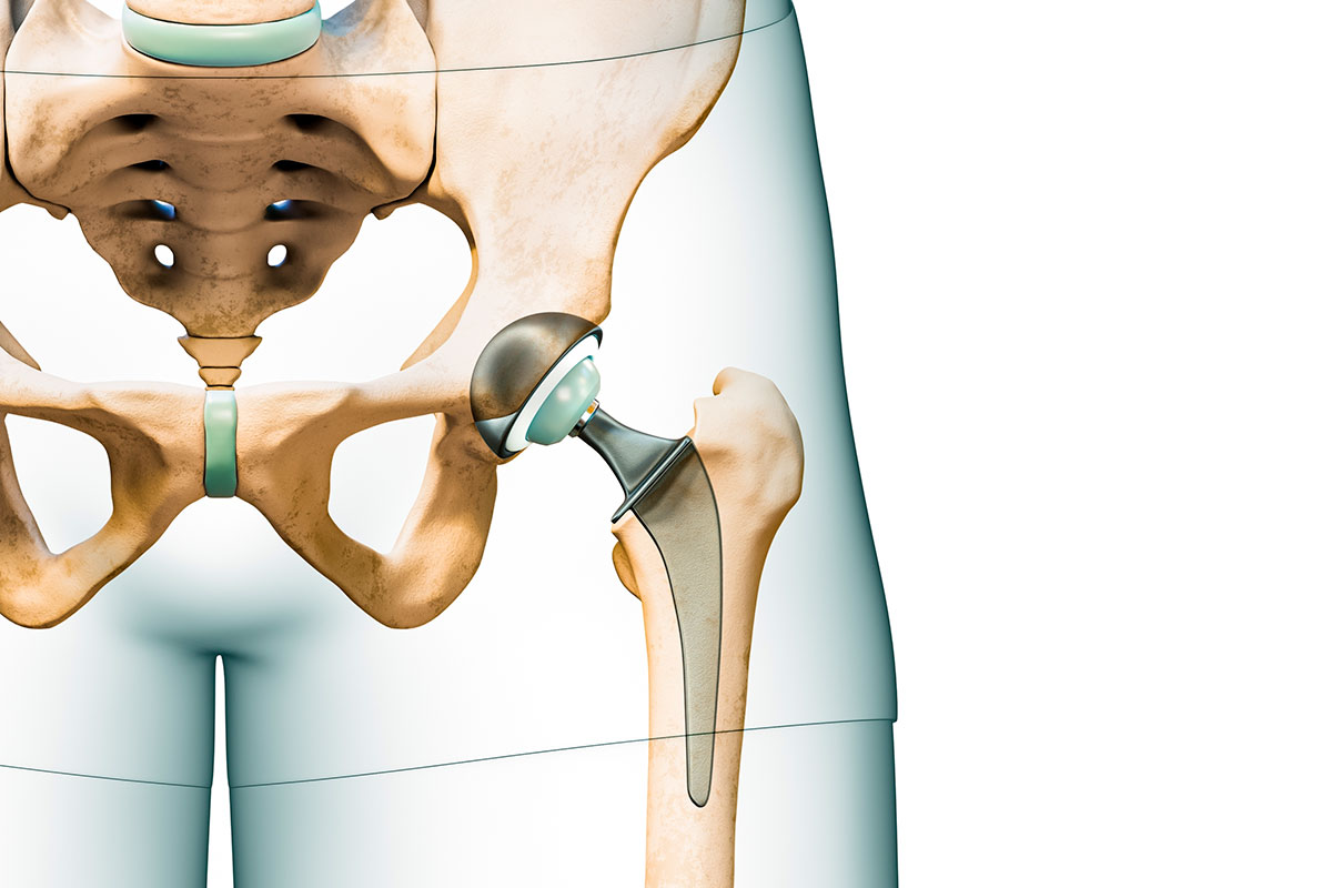 Cirugía ortopédica reconstructiva - Traumatología Gijón
