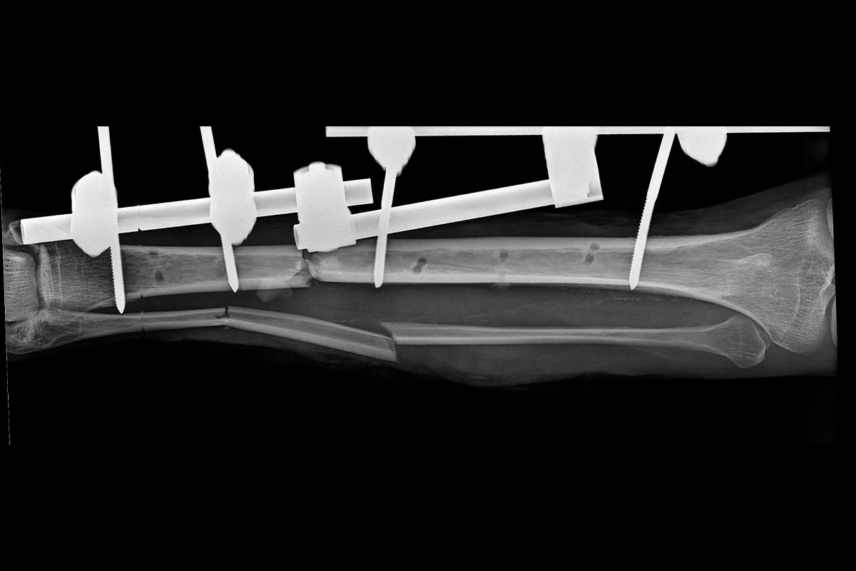 Tratamiento de secuelas postraumáticas - Traumatología Gijón